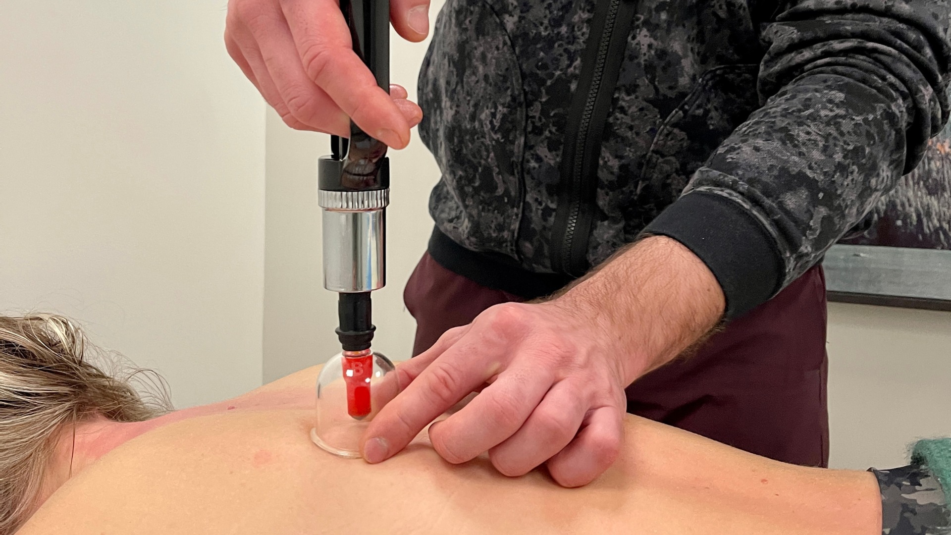 RMT using cupping technique on patient